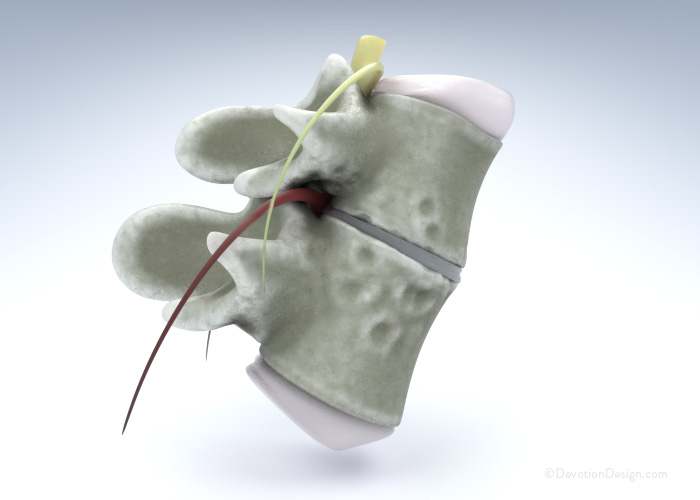 Degenerative Disc Disease