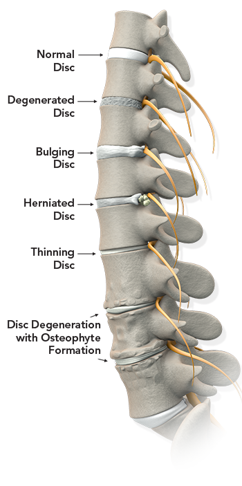 Spinal Decompression Patient